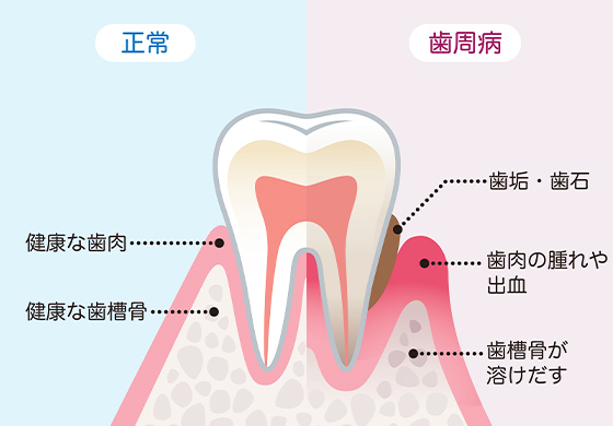 歯周病は「歯を失う原因の第1位」です
